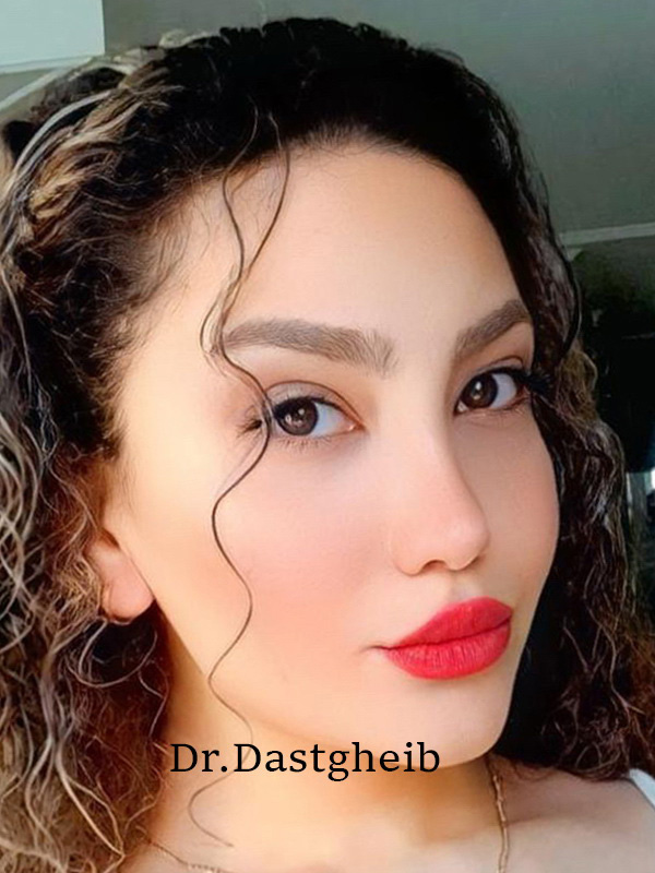 بلفاروپلاستی