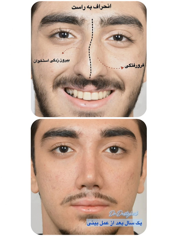 جراحی بینی شکسته و کج