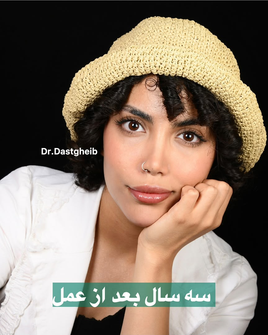 حفظ استحکام و فرم بینی فانتزی سه سال پس از جراحی توسط دکتر دستغیب