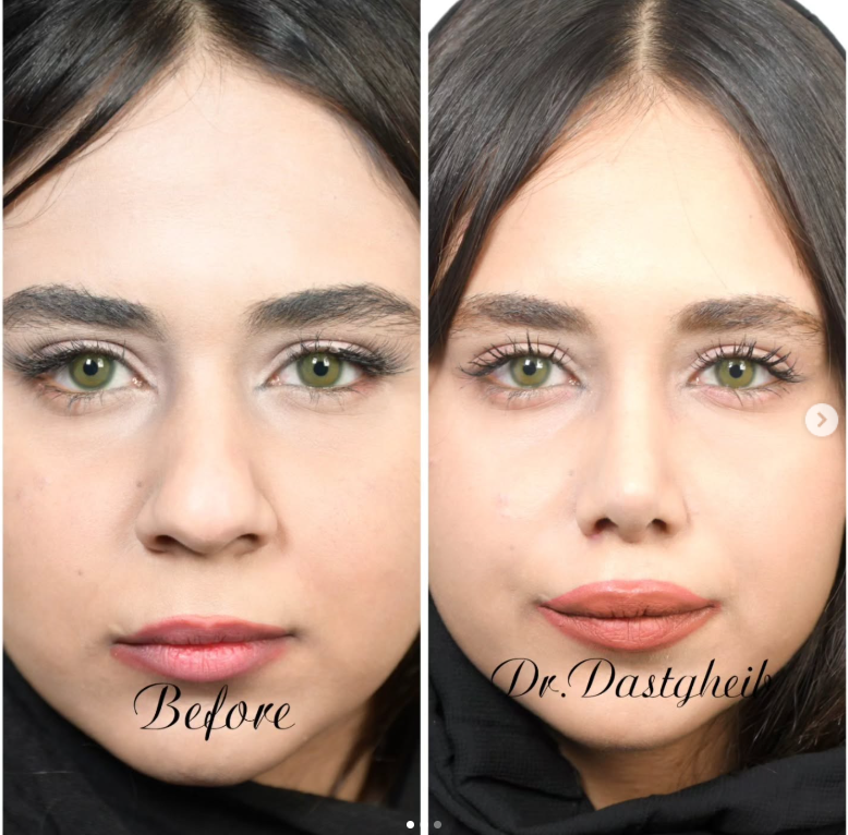 بررسی تناسب بینی و اجزای چهره پیش از جراحی بینی طبیعی مدرن