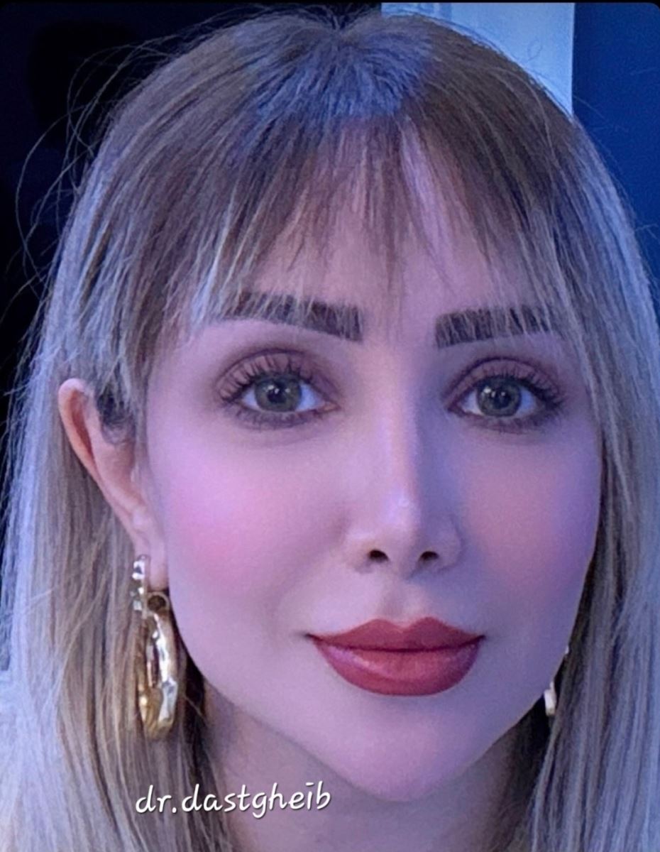 خط کانتور متناسب در جراحی بینی نیمه فانتزی در شیراز