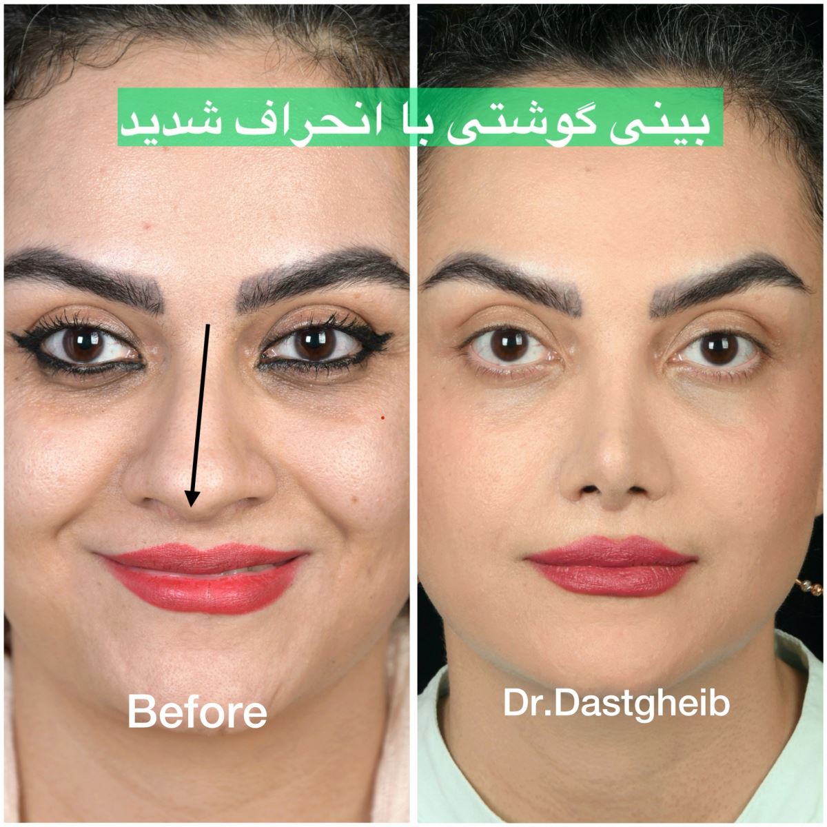 تقویت غضروف در جراحی بینی شکسته و کج توسط دکتر دستغیب