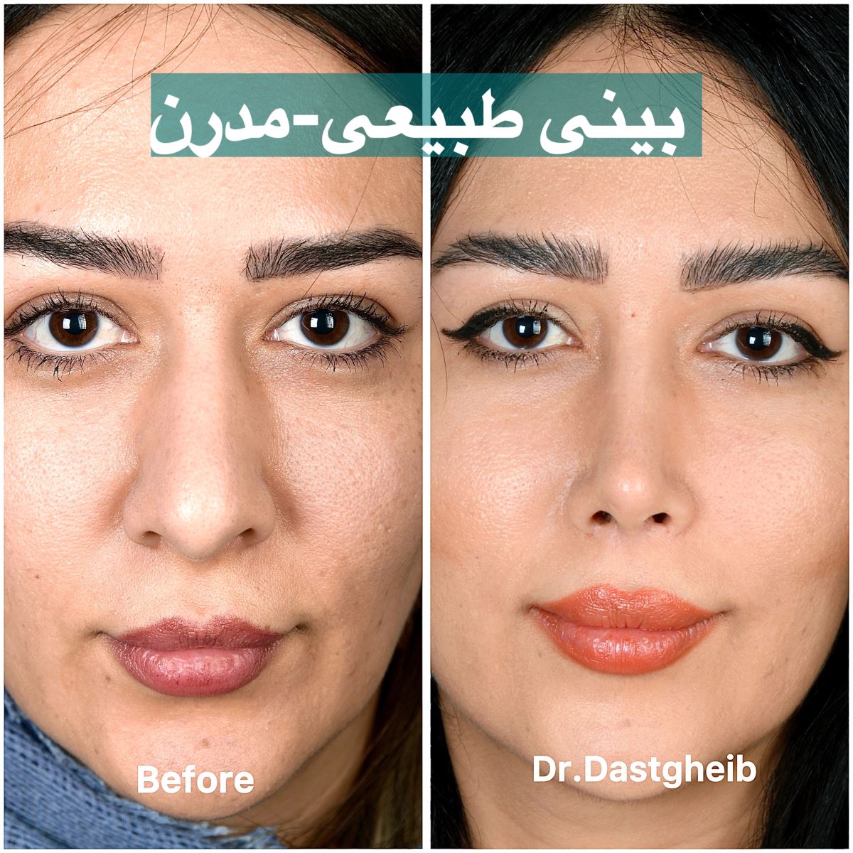 نمونه جراحی بینی گوشتی به فرم طبیعی مدرن با نوک بینی متناسب