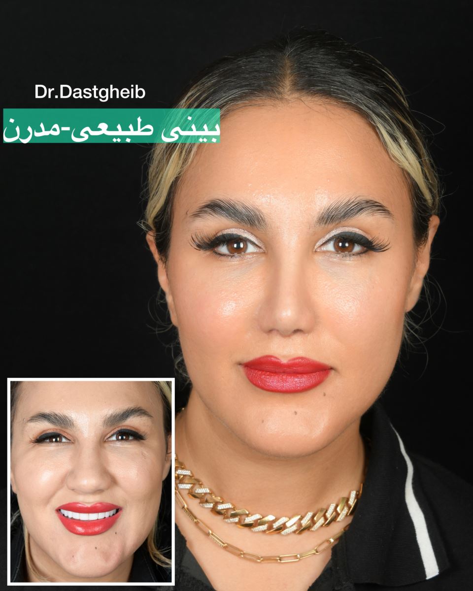 نمونه تغییرات جراحی بینی طبیعی مدرن همراه با حفظ هماهنگی چهره