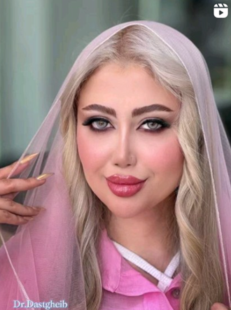 نتیجه جراحی بینی گوشتی توسط دکتر دستغیب در شیراز
